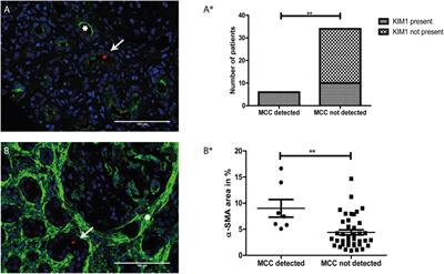 Motile Cilia on Kidney Proximal Tubular Epithelial Cells Are Associated With Tubular Injury and Interstitial Fibrosis